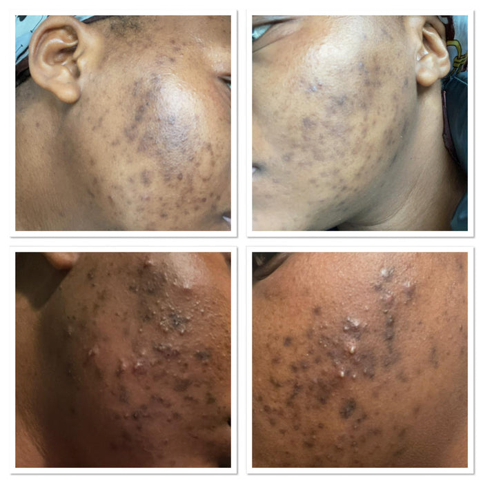 Advanced Face Repair With Vitamin C - Best Acne Control - ShanShar Beauty : The world of beauty.